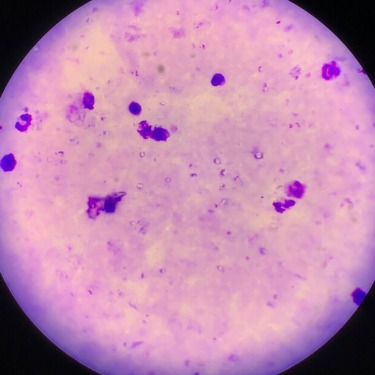 Malaria